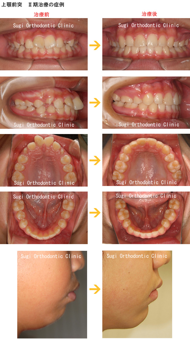 出っ歯 上顎前突 の症例 日野市多摩平 すぎ矯正歯科クリニック