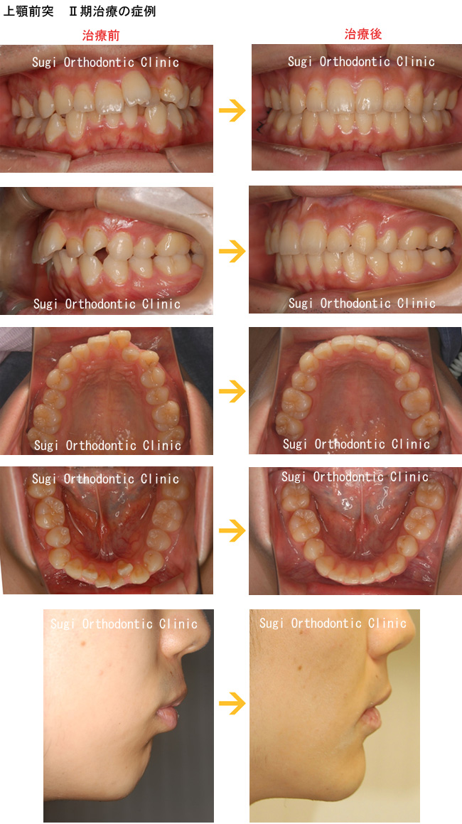 出っ歯（上顎前突）の症例